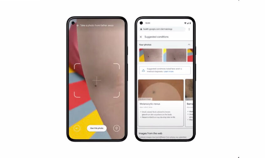 Mobil kamerayı kullanarak cilt sorunlarını (kanser dahil) tespit edin: Google'ın en son projelerinden birinde aradığı şey bu